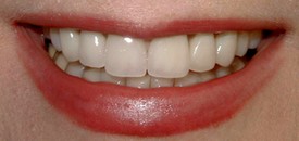 After photo - dentist in Swansea, IL