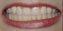 After photo - dentist in Swansea, IL