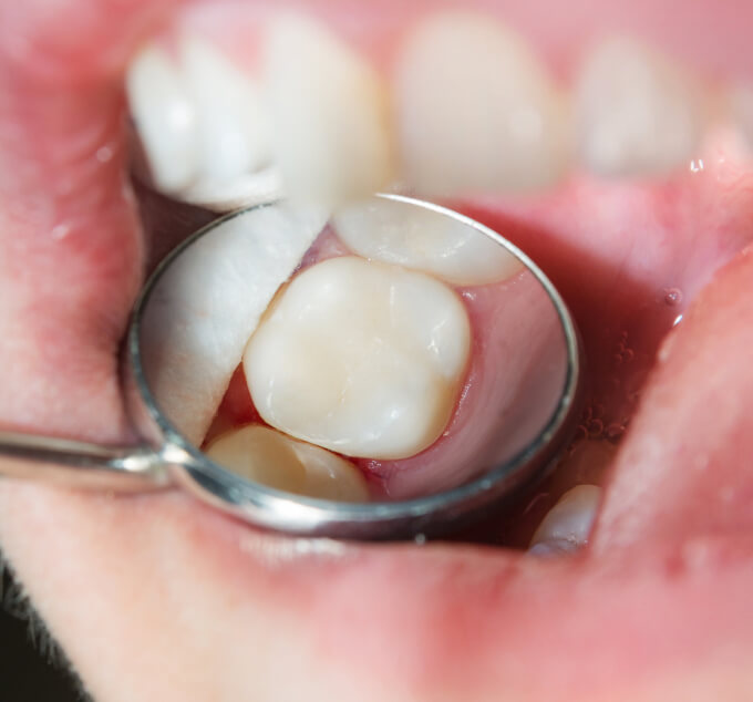 Close up of a tooth - dentist in Swansea, IL