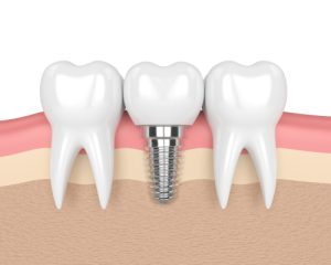 dental implants