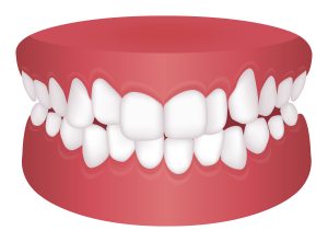 crowded smile
