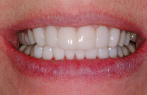 bioclear veneer overlay