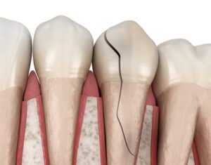 Cracked tooth